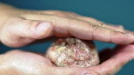 Рецепт котлет, фаршированных грибами